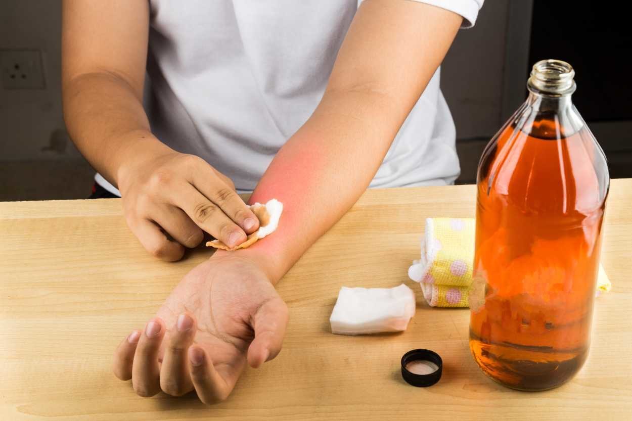 5 Doğal Yöntemle: Evde Uyuza Ne İyi Gelir?