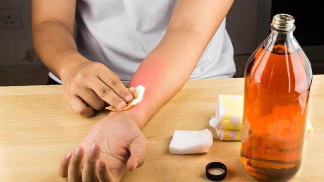 5 Doğal Yöntemle: Evde Uyuza Ne İyi Gelir?